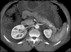 Islet Cell Tumor - CTisus CT Scan