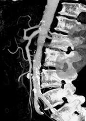 SMA and Celiac Artery From A Common Origin - CTisus CT Scan