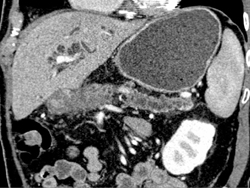 Adenocarcinoma Arising in A Intraductal Papillary Mucinous Neoplasm (IPMN) - CTisus CT Scan