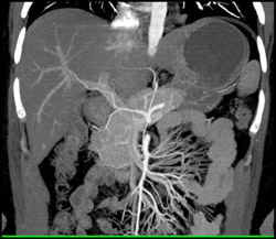 Intraductal Papillary Mucinous Neoplasm (IPMN) - CTisus CT Scan