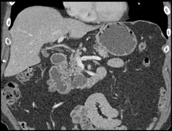 Intraductal Papillary Mucinous Neoplasm (IPMN) - CTisus CT Scan