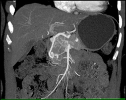 Islet Cell Tumor - CTisus CT Scan