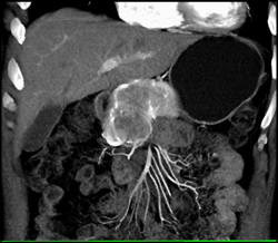 Islet Cell Tumor - CTisus CT Scan