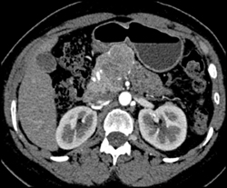 Islet Cell Tumor - CTisus CT Scan