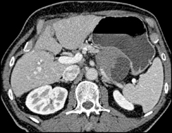 Cystadenoma - CTisus CT Scan