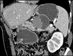 Cystadenoma - CTisus CT Scan