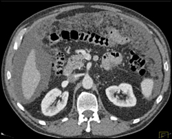 Pancreatic Cancer With Carcinomatosis - CTisus CT Scan