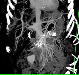 Chronic Calcific Pancreatitis - CTisus CT Scan