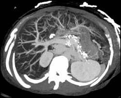 Chronic Pancreatitis - CTisus CT Scan