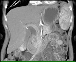 Carcinoma of the Pancreas Encases the Common Bile Duct (CBD) - CTisus CT Scan