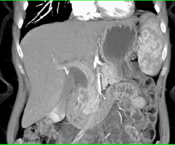 Metastases to the Head of the Pancreas-NSCLC - CTisus CT Scan