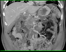 Pancreatic Cancer Invades the PV/SMV Confluence - CTisus CT Scan