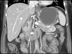 Insulinoma of the Tail of the Pancreas - CTisus CT Scan