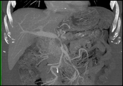 Encased PV/SMV - CTisus CT Scan