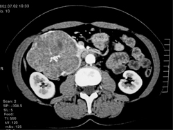 Serous Cystadenoma - CTisus CT Scan