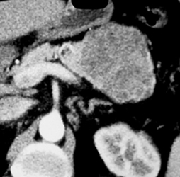 Serous Cystadenoma - CTisus CT Scan