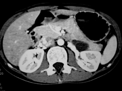 Intraductal Papillary Mucinous Neoplasm (IPMN) - CTisus CT Scan