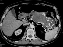 Cystadenoma - CTisus CT Scan