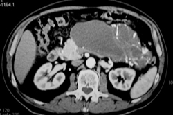 Cystadenoma - CTisus CT Scan