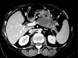 Pancreatic Abscess - CTisus CT Scan