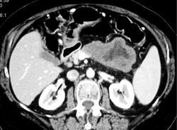 Pancreatic Abscess - CTisus CT Scan