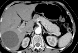 Intraductal Papillary Mucinous Neoplasm (IPMN) - CTisus CT Scan