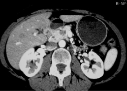 1 Cm Adenocarcinoma - CTisus CT Scan