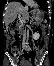 Post Whipple Procedure - CTisus CT Scan