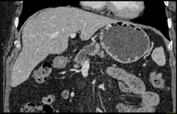 1 Cm Carcinoma - CTisus CT Scan