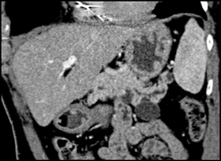 Intraductal Papillary Mucinous Neoplasm (IPMN) - CTisus CT Scan