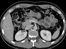 Post Whipple Procedure With Dilated Pancreatic Duct - CTisus CT Scan