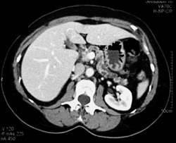 Dilated Pancreatic Duct With Intraductal Papillary Mucinous Neoplasm (IPMN) - CTisus CT Scan