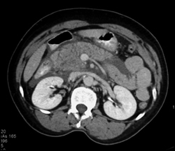 Acute Pancreatitis - CTisus CT Scan