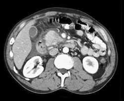 Acute Pancreatitis - CTisus CT Scan