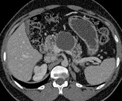 Pancreatic Cysts in Patient With Von-hippel Lindau - CTisus CT Scan