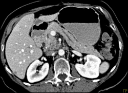 Pancreatic Cancer - CTisus CT Scan