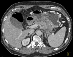 Pancreatic Cancer Encases the Splenic Artery and Vein - CTisus CT Scan