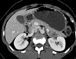 Pancreatic Cancer - CTisus CT Scan