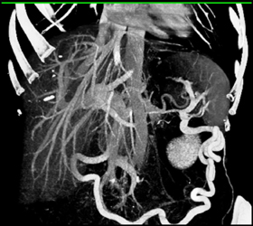 Extensive Collaterals Due to Encasement of Splenic Artery and Vein - CTisus CT Scan