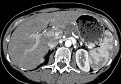 Pancreatic Cancer - CTisus CT Scan