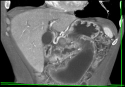 Pancreatic Cancer With Dilated Pancreatic Duct - CTisus CT Scan