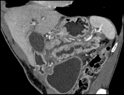 Pancreatic Cancer With Dilated Pancreatic Duct - CTisus CT Scan