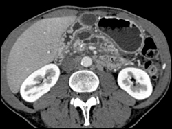 Pancreatic Cancer With Dilated Pancreatic Duct - CTisus CT Scan