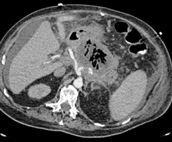 Pancreatic Abscess - CTisus CT Scan