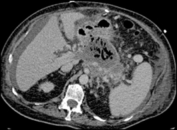 Pancreatic Abscess - CTisus CT Scan