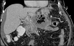 Pancreatic Abscess - CTisus CT Scan