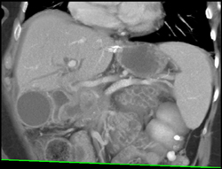 Pancreatic Cancer Encases the PV/SMV - CTisus CT Scan