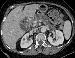 Pancreatic Cancer Encases the PV/SMV - CTisus CT Scan