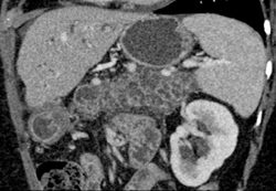 Pancreatic Cancer Encases the PV/SMV - CTisus CT Scan