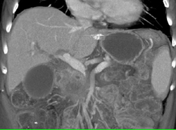 Pancreatic Cancer Encases the PV/SMV - CTisus CT Scan